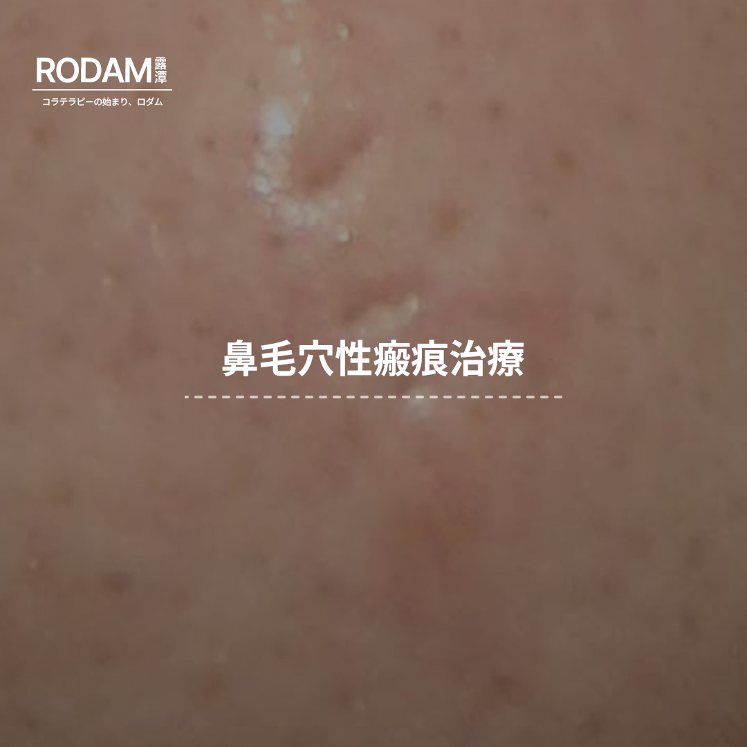 鼻毛穴性瘢コラテラピー治療、ロダム韓医院